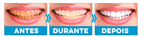 Clareador Dental - ®V34 (Clareamento instantâneo)