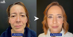 Creme Reparador de Olhos Caidos - LifitEye®