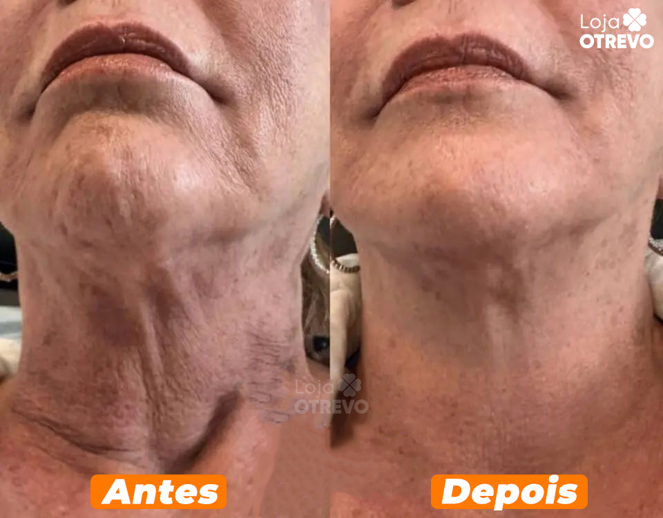 HoneySkin® - Oléo Rejuvenescedor e Redutor de Papada (100% MEL PURO)