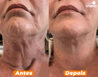 HoneySkin® - Oléo Rejuvenescedor e Redutor de Papada (100% MEL PURO)