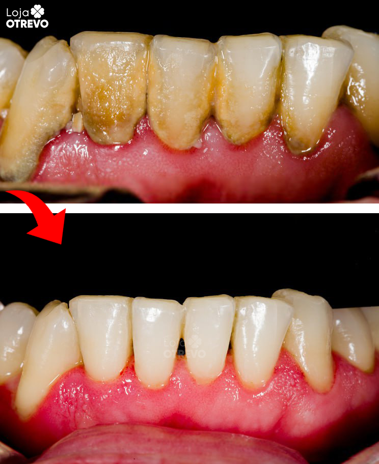 JatoClean®  - Irrigador Oral para Limpeza Bucal