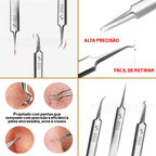 Pinças Super Skin - Kit Removedor de Cravos e Espinhas (3 Peças)