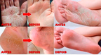 Cera Removedora de Calos e Rachaduras - ®Foot Gold