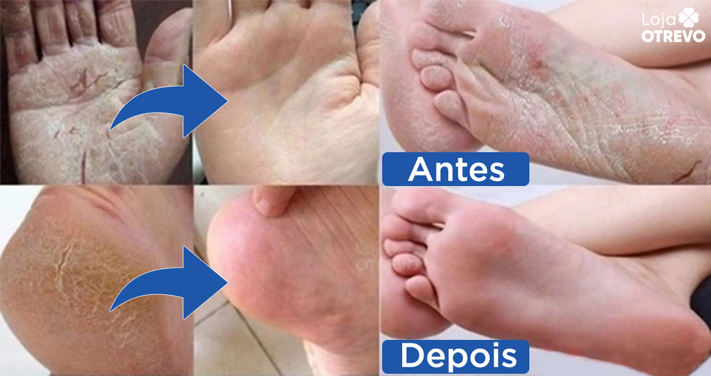 Bastão Removedor de Calos e Rachaduras (SUPER HIDRATANTE) BabyFeet®