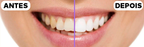 Pasta Super Clareadora Dental -  ®CristalTeeh
