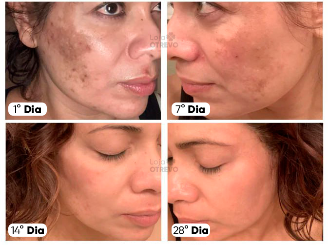 Creme Clareador de Manchas Escuras à Base de Leite - Milk Whitening® (Clareamento 100% Comprovado)