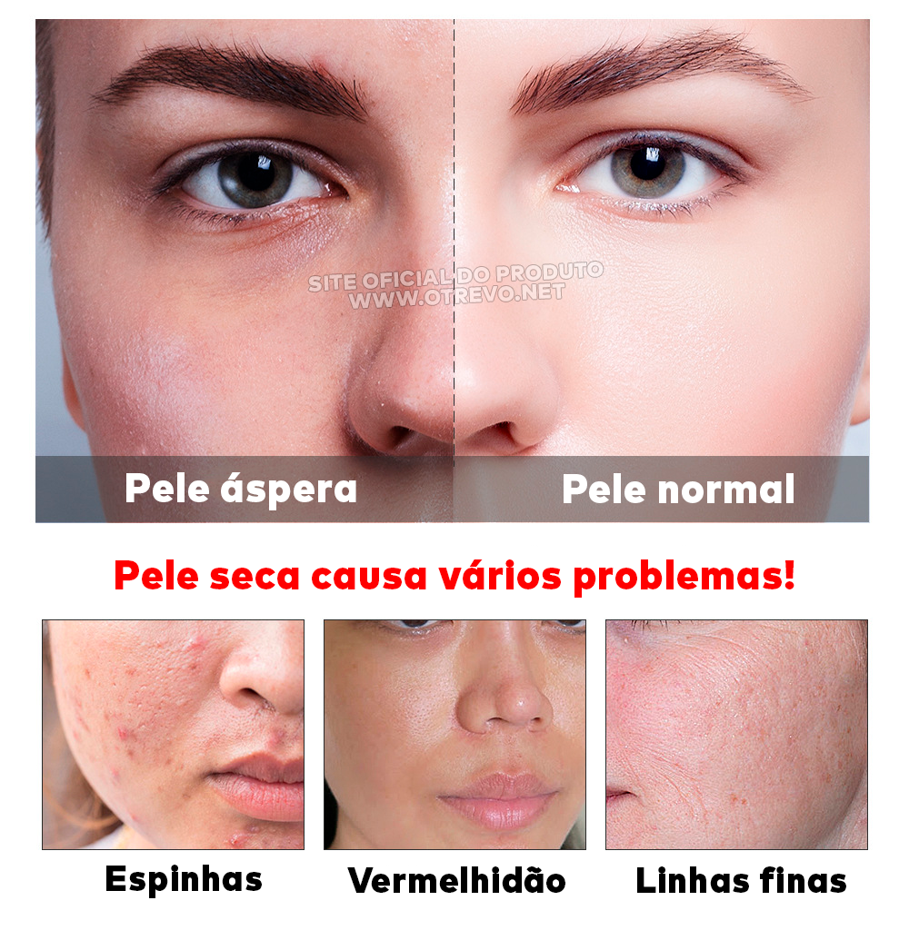 Sérum Removedor de Acne e Poros Dilatados - AcneLanbéna®