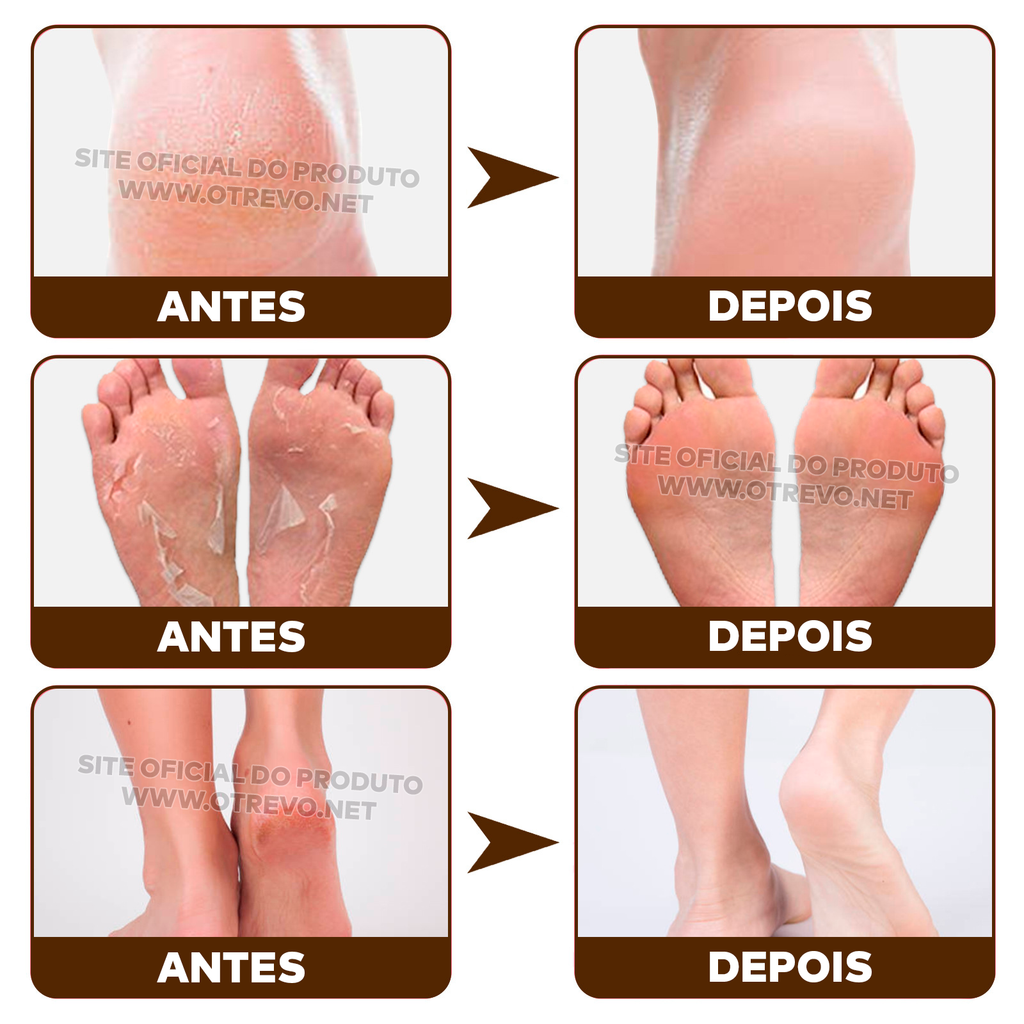 Bastão Removedor de Calos e Rachaduras (SUPER HIDRATANTE) BabyFeet®