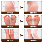 Bastão Removedor de Calos e Rachaduras (SUPER HIDRATANTE) BabyFeet®