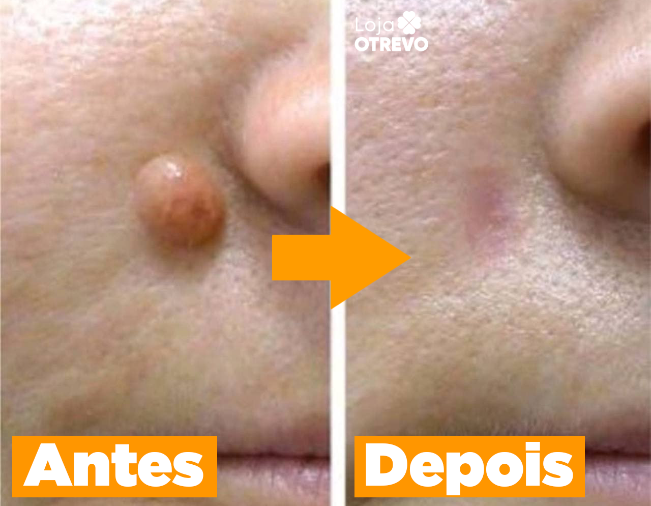 BeeTag - Spray Removedor Instantâneo de Verrugas e Sinais da Pele (EFEITO IMEDIATO)