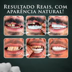 Facetas Dentárias Removíveis ®Nature Smile