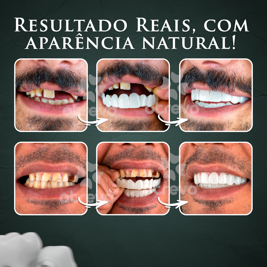Facetas Dentárias Removíveis ®Nature Smile