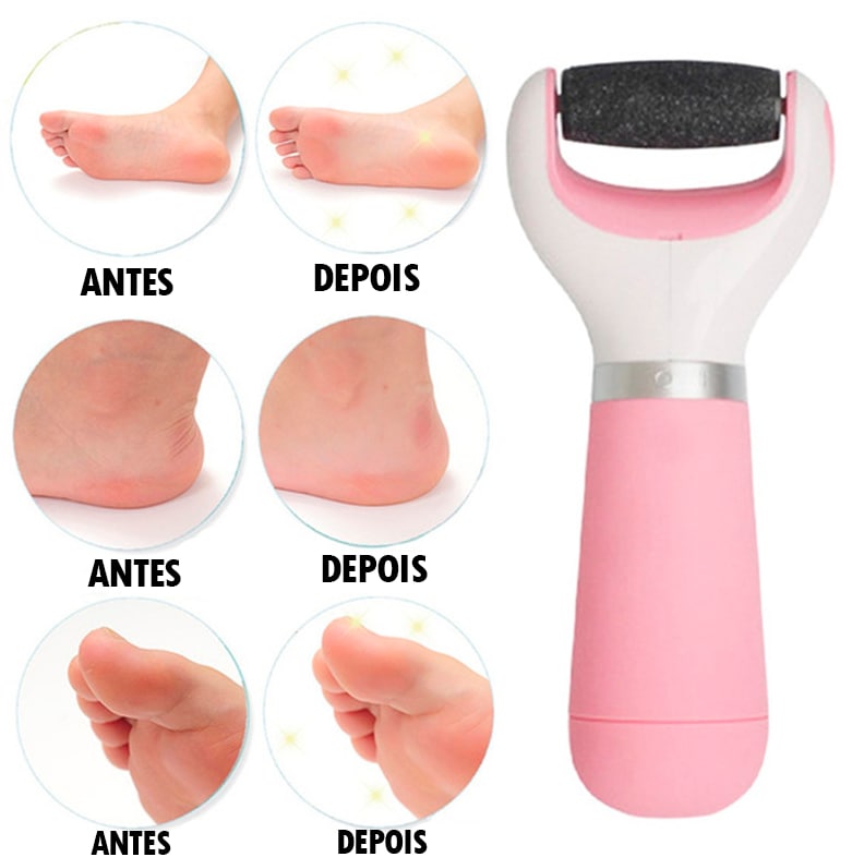 Removedor de Calos Profissional Portátil - CalurRemover® (REMOVE 100% DOS CALOS E RACHADURAS)