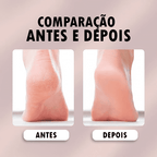 Lixa de pé eletrico mão removedora de calos + BRINDE (LIXA GROSSA) - Remuver Hydrati®