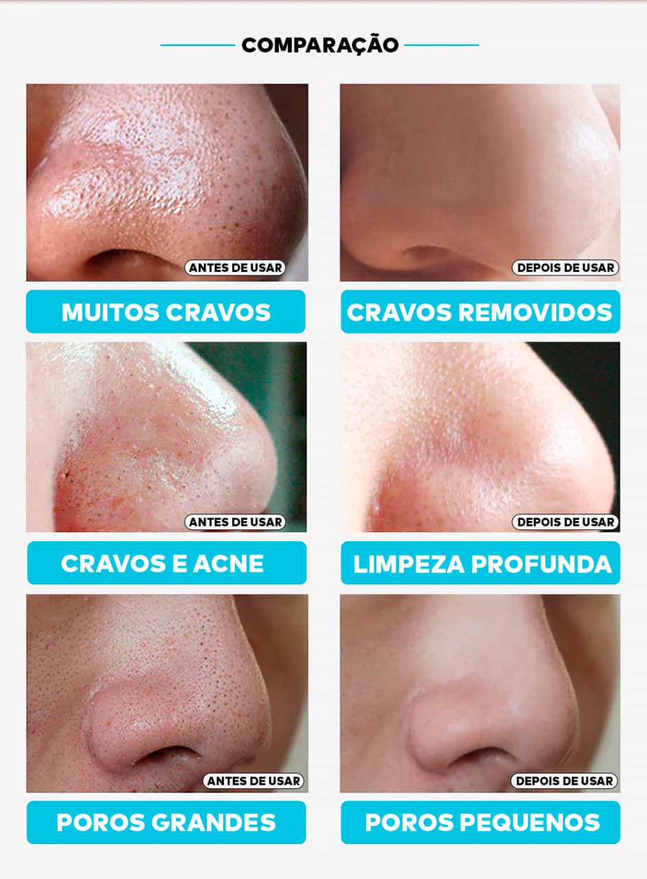 Removedor de Cravos Lanbena + 60 Adesivos Aplicadores (Brinde) 2 em 1